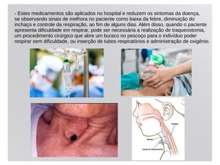 - Estes medicamentos são aplicados no hospital e reduzem os sintomas da doença,
se observando sinais de melhora no paciente como baixa da febre, diminuição do
inchaço e controle da respiração, ao fim de alguns dias. Além disso, quando o paciente
apresenta dificuldade em respirar, pode ser necessária a realização de traqueostomia,
um procedimento cirúrgico que abre um buraco no pescoço para o indivíduo poder
respirar sem dificuldade, ou inserção de tubos respiratórios e administração de oxigênio.
 