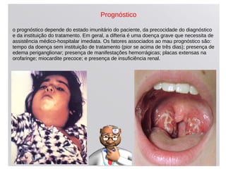 o prognóstico depende do estado imunitário do paciente, da precocidade do diagnóstico
e da instituição do tratamento. Em geral, a difteria é uma doença grave que necessita de
assistência médico-hospitalar imediata. Os fatores associados ao mau prognóstico são:
tempo da doença sem instituição de tratamento (pior se acima de três dias); presença de
edema periganglionar; presença de manifestações hemorrágicas; placas extensas na
orofaringe; miocardite precoce; e presença de insuficiência renal.
Prognóstico
 