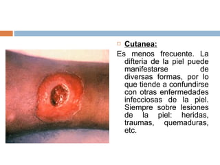  Cutanea:
Es menos frecuente. La
  difteria de la piel puede
  manifestarse           de
  diversas formas, por lo
  que tiende a confundirse
  con otras enfermedades
  infecciosas de la piel.
  Siempre sobre lesiones
  de la piel: heridas,
  traumas, quemaduras,
  etc.
 