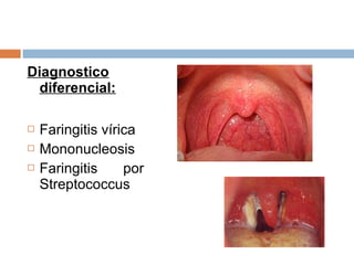 Diagnostico
  diferencial:

   Faringitis vírica
   Mononucleosis
   Faringitis     por
    Streptococcus
 