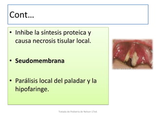 Cont…
• Inhibe la síntesis proteica y
causa necrosis tisular local.
• Seudomembrana
• Parálisis local del paladar y la
hipofaringe.
Tratado de Pediatria de Nelson 17ed.
 