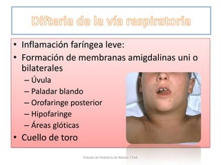 • Inflamación faríngea leve:
• Formación de membranas amigdalinas uni o
bilaterales
– Úvula
– Paladar blando
– Orofaringe posterior
– Hipofaringe
– Áreas glóticas
• Cuello de toro
Tratado de Pediatria de Nelson 17ed.
 