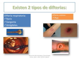 Difteria respiratoria:
Nariz
Garganta
Amígdalas.
Difteria cutánea:
Piel.
Manual de Microbiología y Parasitología
Clínica. WHO. 1994. (ICP/EPI 038(C)).
 