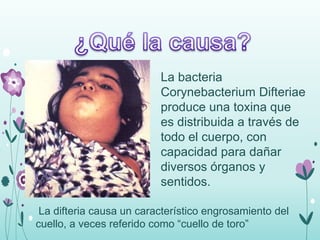 La difteria causa un característico engrosamiento del
cuello, a veces referido como “cuello de toro”
La bacteria
Corynebacterium Difteriae
produce una toxina que
es distribuida a través de
todo el cuerpo, con
capacidad para dañar
diversos órganos y
sentidos.
 