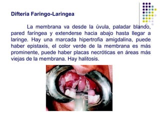 Difteria Faringo-Laringea
La membrana va desde la úvula, paladar blando,
pared faríngea y extenderse hacia abajo hasta llegar a
laringe. Hay una marcada hipertrofia amigdalina, puede
haber epistaxis, el color verde de la membrana es más
prominente, puede haber placas necróticas en áreas más
viejas de la membrana. Hay halitosis.
 