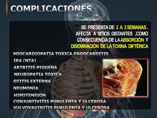 SE PRESENTADE 2 A 3SEMANAS.
AFECTA A SITIOS DISTANTES ,COMO
CONSECUENCIADELAABSORCIÓN Y
DISEMINACIÓN DELATOXINA DIFTÉRICA