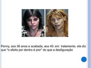 Penny, aos 36 anos e acabada, aos 40: em tratamento, ela diz
que "o efeito por dentro é pior" do que a desfiguração
 