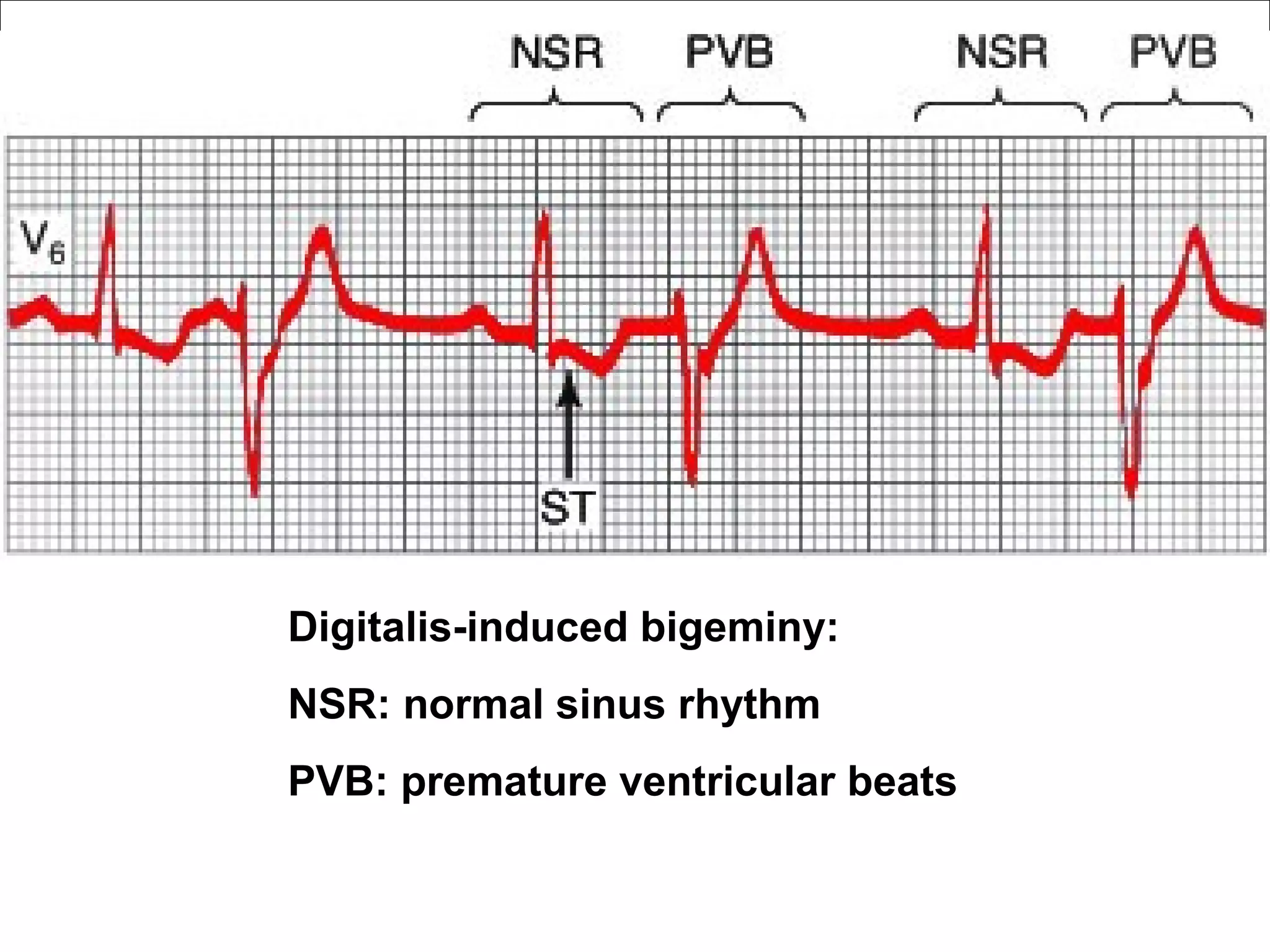 Digitalis-induced bigeminy:
NSR: normal sinus rhythm
PVB: premature ventricular beats
 