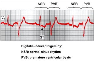 Digitalis-induced bigeminy:
NSR: normal sinus rhythm
PVB: premature ventricular beats
 