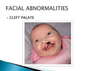  CLEFT PALATE
 