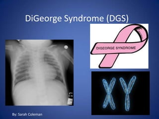 DiGeorge Syndrome (DGS)
By: Sarah Coleman
 