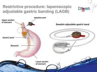 Restrictive procedure: laparoscopic
adjustable gastric banding (LAGB)
Lower section
of stomach
Upper section
of stomach
Gastric band
Stomach
Injection port
Swedish adjustable gastric band
 