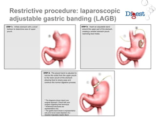 Restrictive procedure: laparoscopic
adjustable gastric banding (LAGB)
 