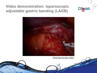 Video demonstration: laparoscopic
adjustable gastric banding (LAGB)
Click here to play video
 