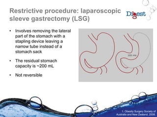 Restrictive procedure: laparoscopic
sleeve gastrectomy (LSG)
• Involves removing the lateral
part of the stomach with a
stapling device leaving a
narrow tube instead of a
stomach sack
• The residual stomach
capacity is ~200 mL
• Not reversible
1. Obesity Surgery Society of
Australia and New Zealand, 2008.
 