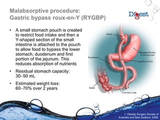 Malabsorptive procedure:
Gastric bypass roux-en-Y (RYGBP)
• A small stomach pouch is created
to restrict food intake and then a
Y-shaped section of the small
intestine is attached to the pouch
to allow food to bypass the lower
stomach, duodenum and first
portion of the jejunum. This
reduces absorption of nutrients
• Residual stomach capacity:
3050 mL
• Estimated weight loss:
6070% over 2 years
1. Obesity Surgery Society of
Australia and New Zealand, 2008.
 