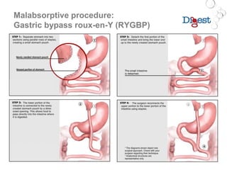 Malabsorptive procedure:
Gastric bypass roux-en-Y (RYGBP)
 
