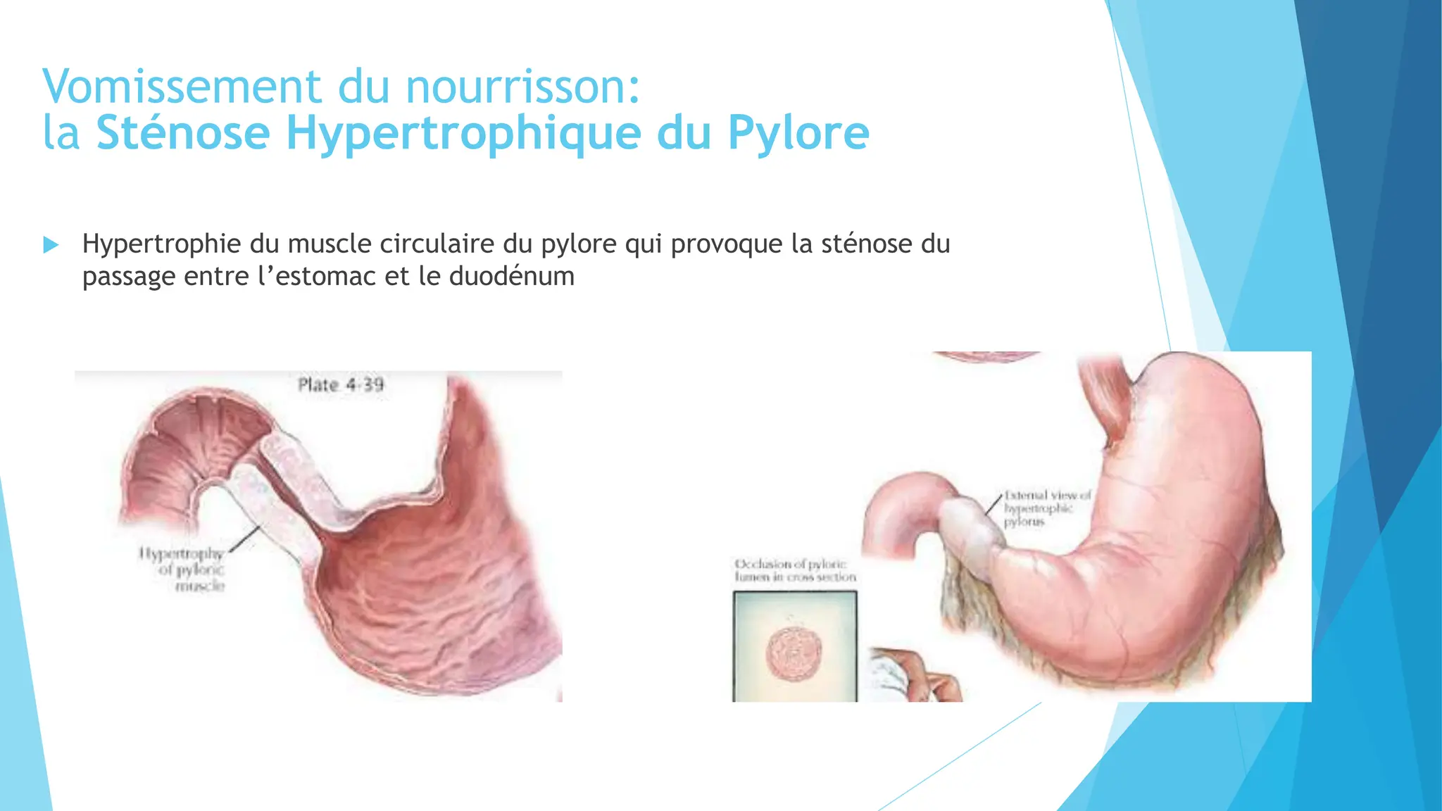 sténose hypertrophique du pylore RGO.pptx