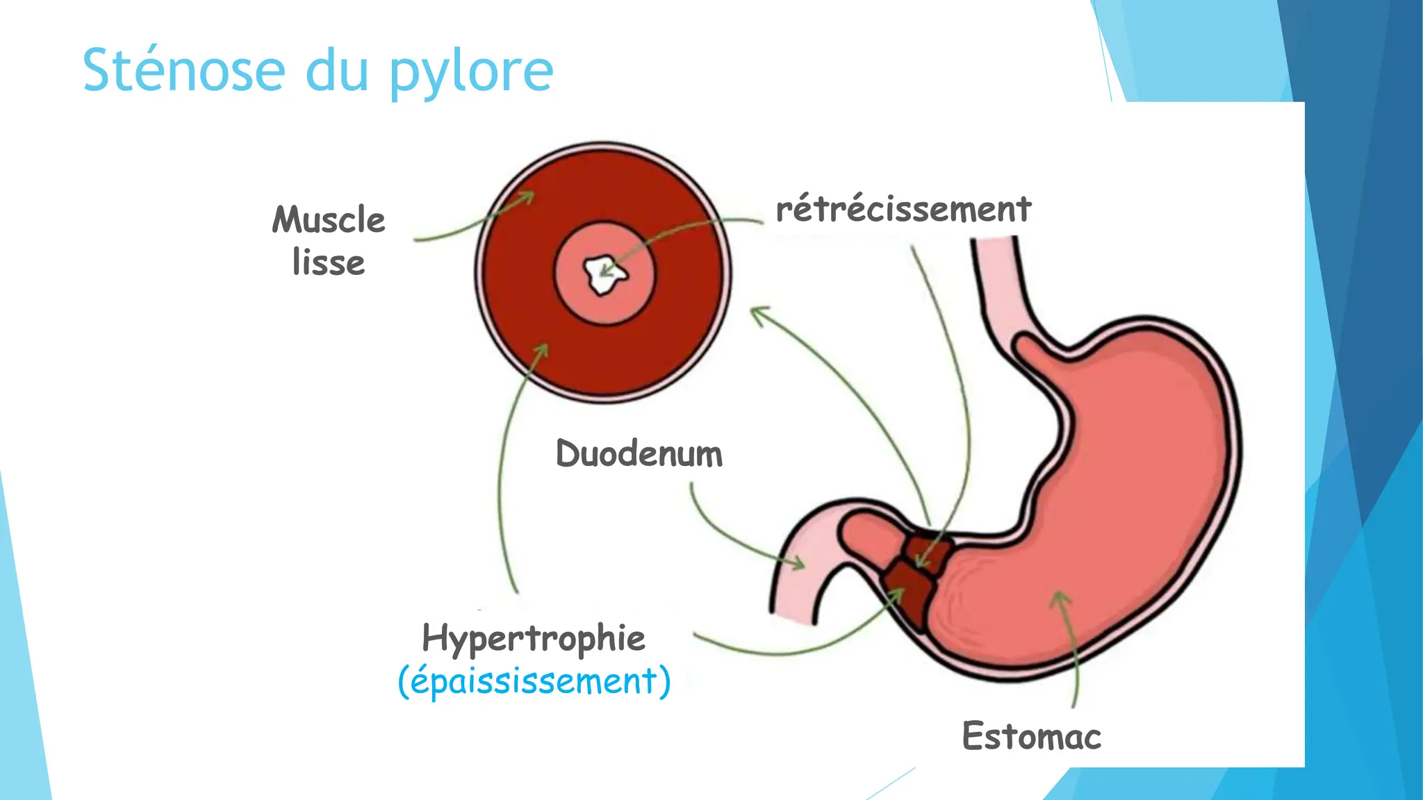 sténose hypertrophique du pylore RGO.pptx