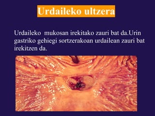 Urdaileko ultzera
Urdaileko mukosan irekitako zauri bat da.Urin
gastriko gehiegi sortzerakoan urdailean zauri bat
irekitzen da.
 