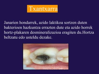 Txantxarra
Janarien hondarrek, azido laktikoa sortzen duten
bakterioen hazkuntza errazten dute eta azido horrek
hortz-plakaren desmineralizazioa eragiten du.Hortza
beltzatu edo usteldu dezake.
 