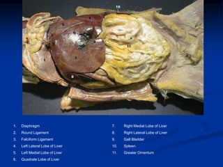 1. Diaphragm 7. Right Medial Lobe of Liver
2. Round Ligament 8. Right Lateral Lobe of Liver
3. Falciform Ligament 9. Gall Bladder
4. Left Lateral Lobe of Liver 10. Spleen
5. Left Medial Lobe of Liver 11. Greater Omentum
6. Quadrate Lobe of Liver
 