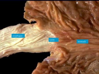 esophagus
GES
stomach
 