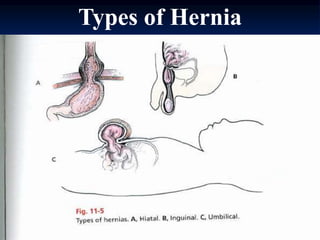 Types of Hernia
 