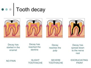 Tooth decay Decay has started in the enamel NO PAIN Decay has reached the dentine SLIGHT TOOTHACHE Decay reaches the pulp SEVERE TOOTHACHE Decay has spread down to the nerve root EXCRUCIATING  PAIN!! 