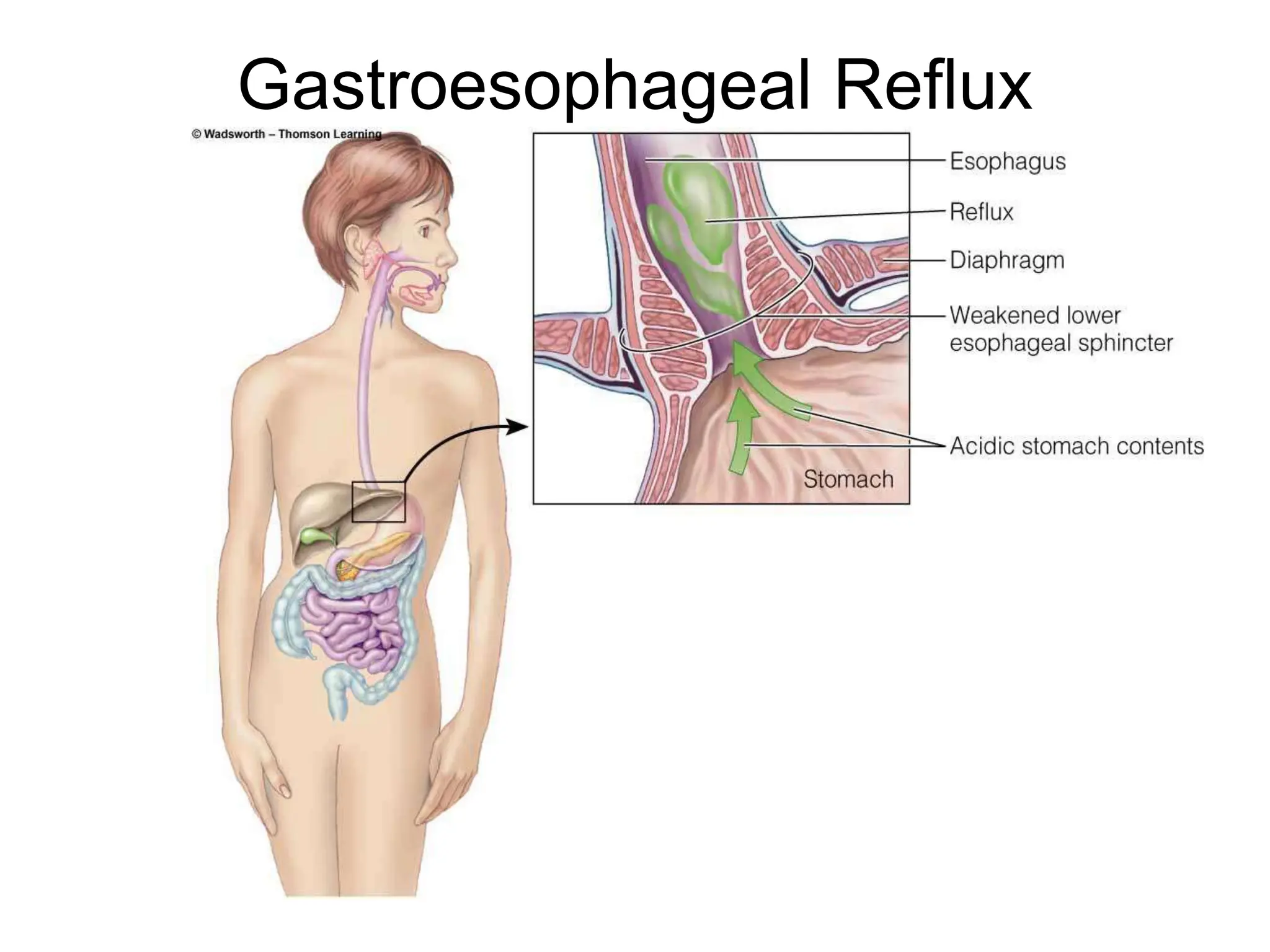 Gastroesophageal Reflux
 