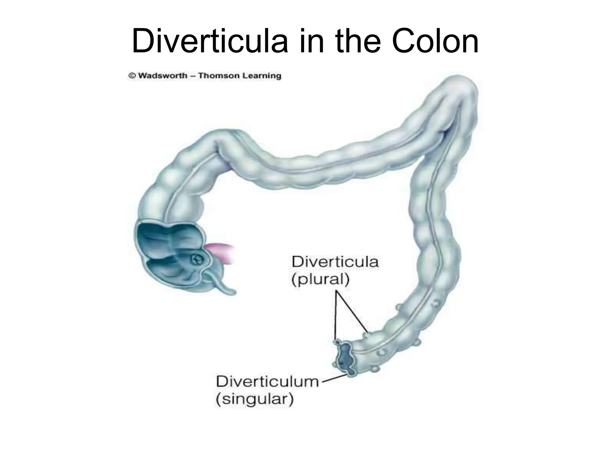 Diverticula in the Colon
 