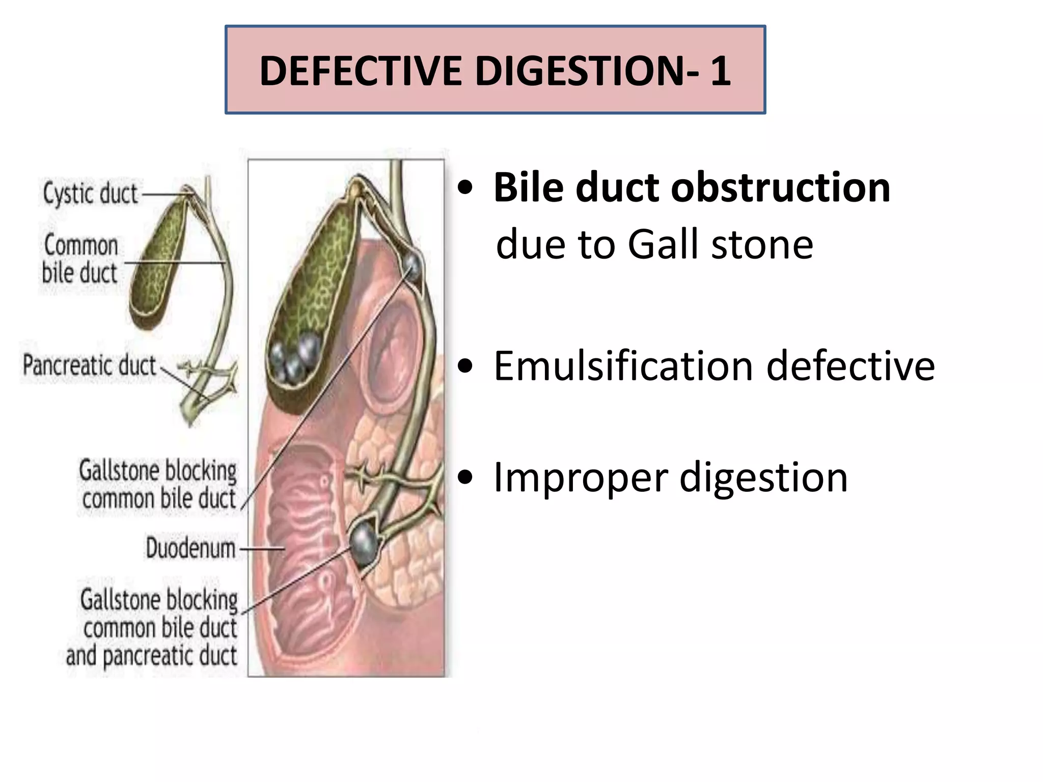 • Bile duct obstruction
due to Gall stone
• Emulsification defective
• Improper digestion
DEFECTIVE DIGESTION- 1
 