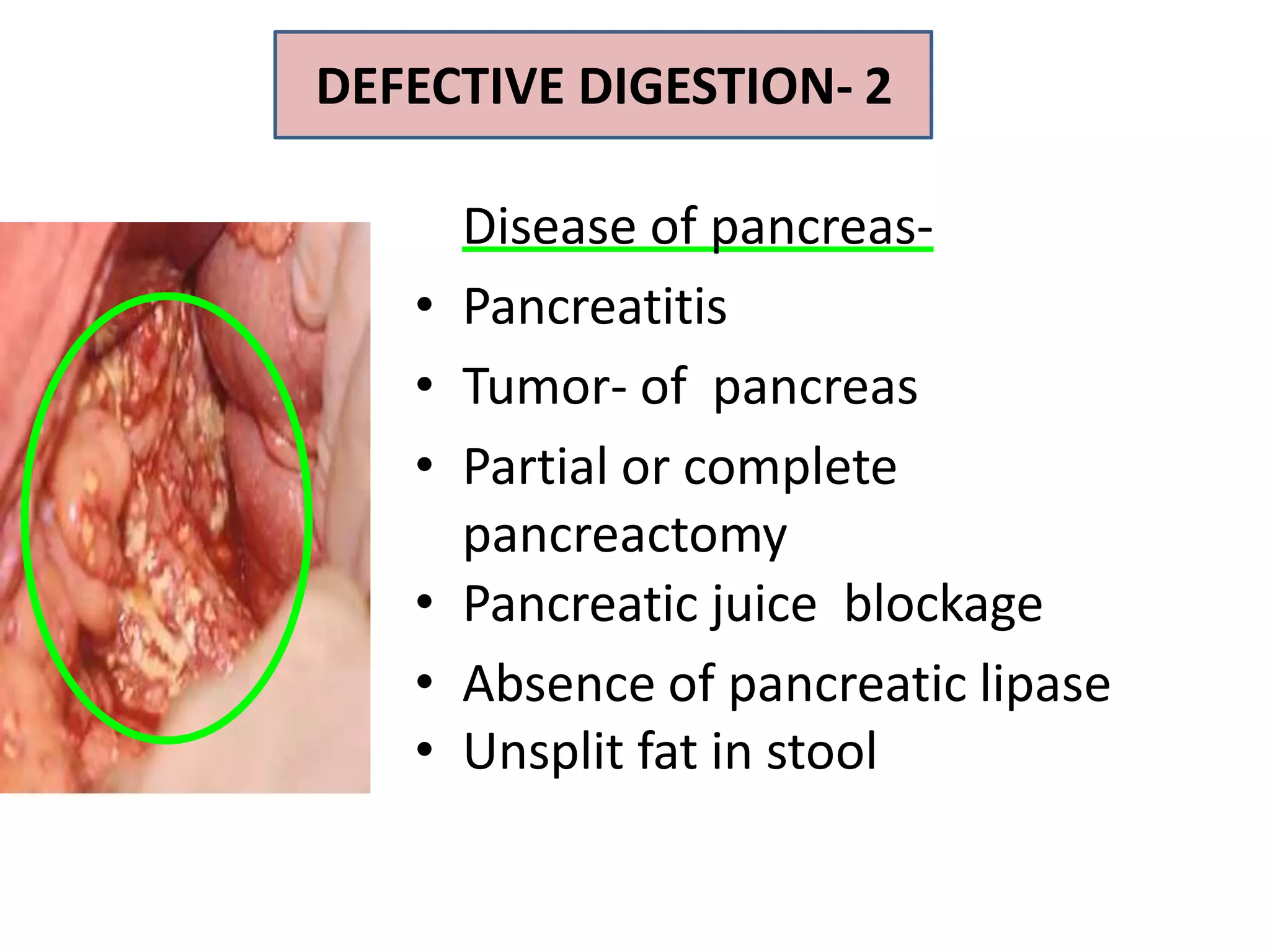 Disease of pancreas-
• Pancreatitis
• Tumor- of pancreas
• Partial or complete
pancreactomy
• Pancreatic juice blockage
• Absence of pancreatic lipase
• Unsplit fat in stool
DEFECTIVE DIGESTION- 2
 