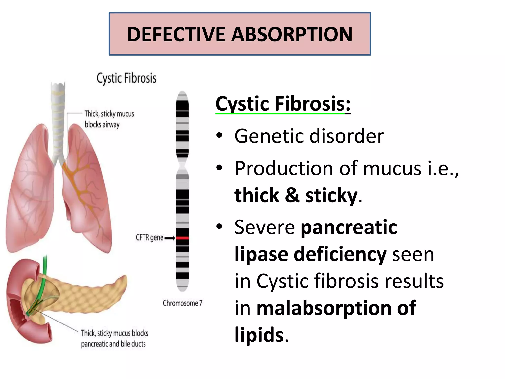DEFECTIVE ABSORPTION
Cystic Fibrosis:
• Genetic disorder
• Production of mucus i.e.,
thick & sticky.
• Severe pancreatic
lipase deficiency seen
in Cystic fibrosis results
in malabsorption of
lipids.
 