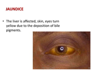 JAUNDICE
• The liver is affected, skin, eyes turn
yellow due to the deposition of bile
pigments.
•86
•HSE Zoology blog
 