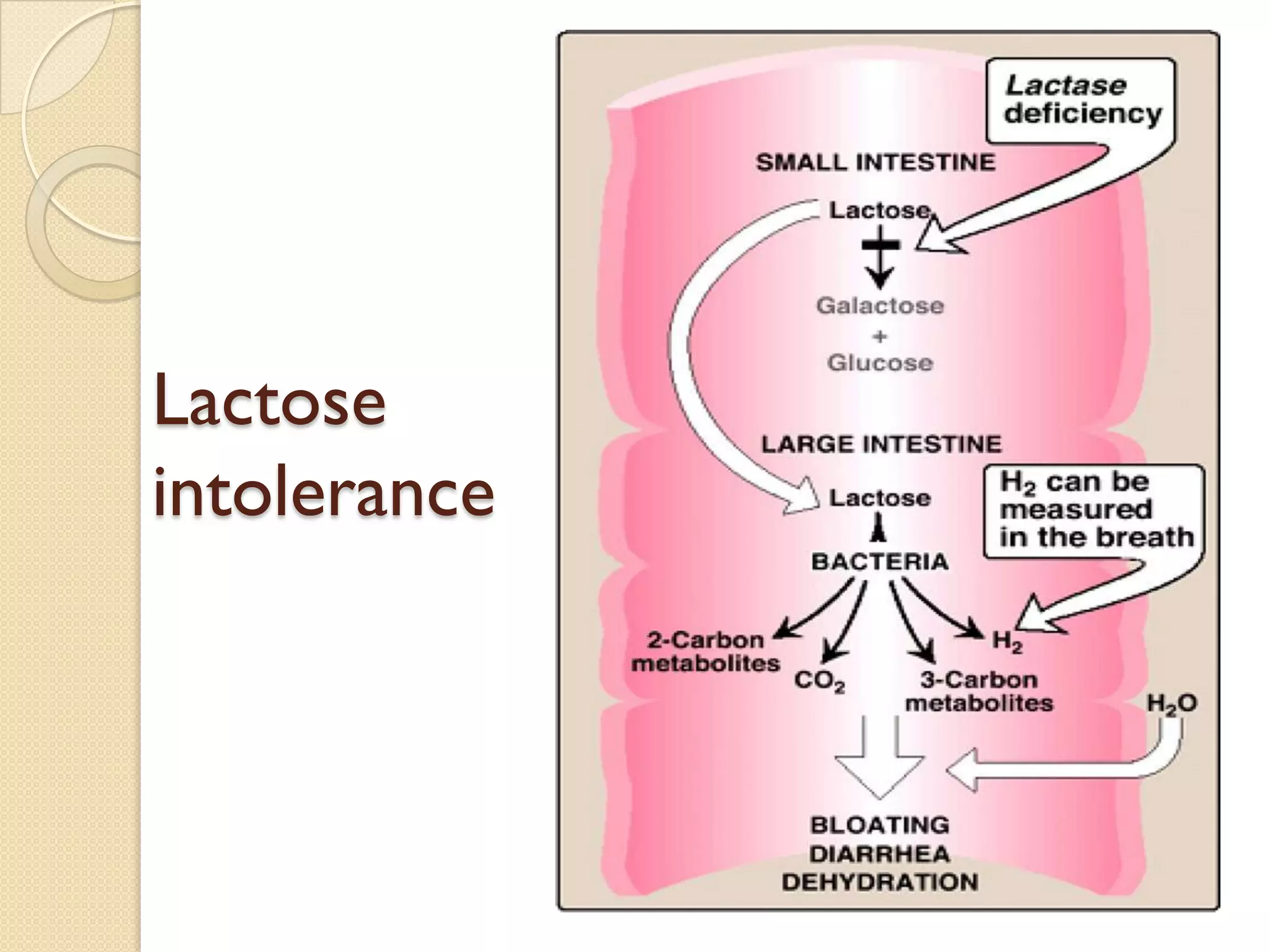 Lactose
intolerance
 