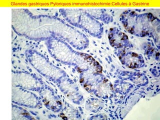 Glandes gastriques Pyloriques immunohistochimie:Cellules à Gastrine
 