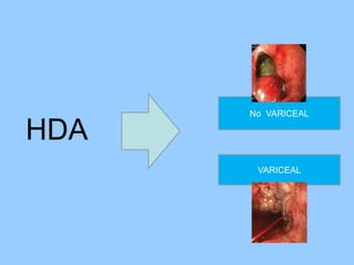 HDA
No VARICEAL
VARICEAL
 