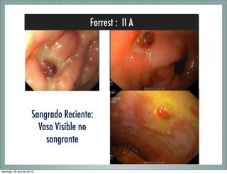 Forrest : II A
Sangrado Reciente:
Vaso Visible no
sangrante
domingo, 26 de julio de 15
 