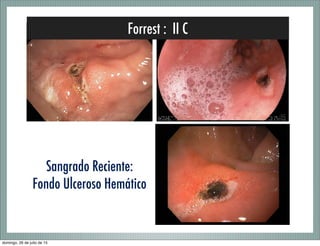 Forrest : II C
Sangrado Reciente:
Fondo Ulceroso Hemático
domingo, 26 de julio de 15
 