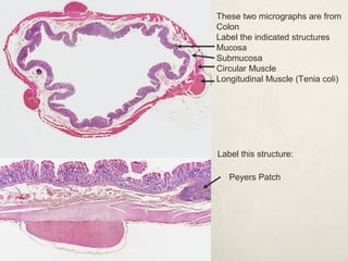 These two micrographs are from 
Colon 
Label the indicated structures 
Mucosa 
Submucosa 
Circular Muscle 
Longitudinal Muscle (Tenia coli) 
Label this structure: 
Peyers Patch 
 