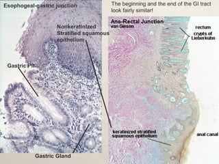 Esophogeal-gastric junction 
Gastric Pit 
Nonkeratinized 
Stratified squamous 
epithelium 
Gastric Gland 
The beginning and the end of the GI tract 
look fairly similar! 
