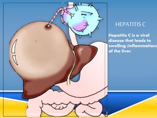 HEPATITIS C 
Hepatitis C is a viral 
disease that leads to 
swelling (inflammation) 
of the liver. 
 