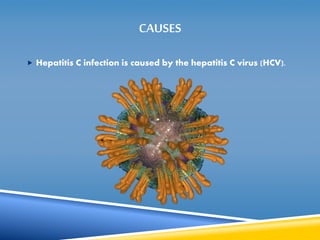 CAUSES 
 Hepatitis C infection is caused by the hepatitis C virus (HCV). 
 