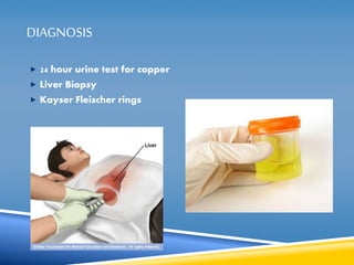 DIAGNOSIS 
 24 hour urine test for copper 
 Liver Biopsy 
 Kayser Fleischer rings 
 