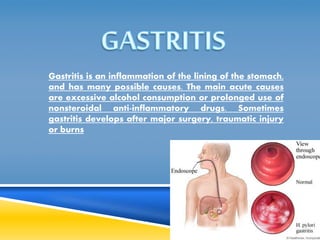 Gastritis is an inflammation of the lining of the stomach, 
and has many possible causes. The main acute causes 
are excessive alcohol consumption or prolonged use of 
nonsteroidal anti-inflammatory drugs. Sometimes 
gastritis develops after major surgery, traumatic injury 
or burns 
 