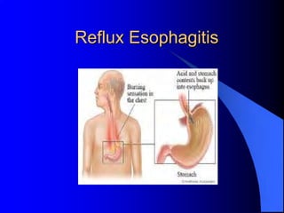 Reflux Esophagitis
 
