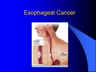 Esophageal Cancer
 