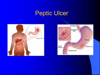 Peptic Ulcer
 