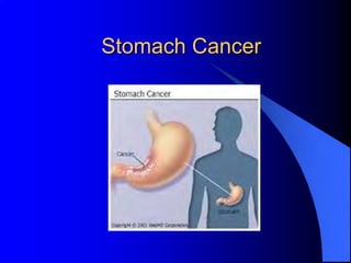 Stomach Cancer
 